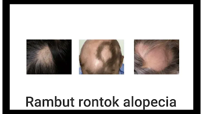 La alopecia areata se cura sola